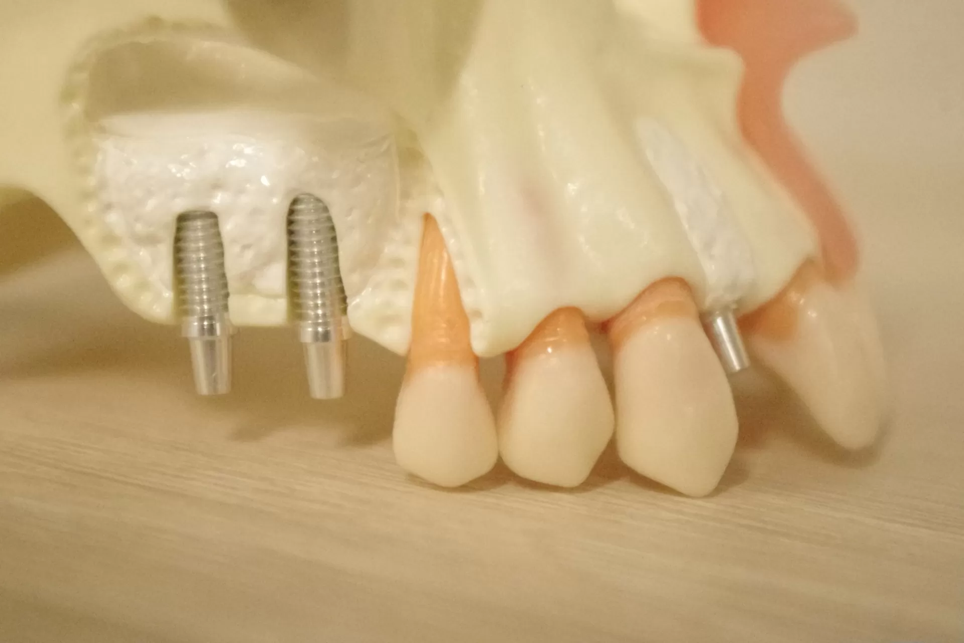 信頼性の高い最先端のインプラント