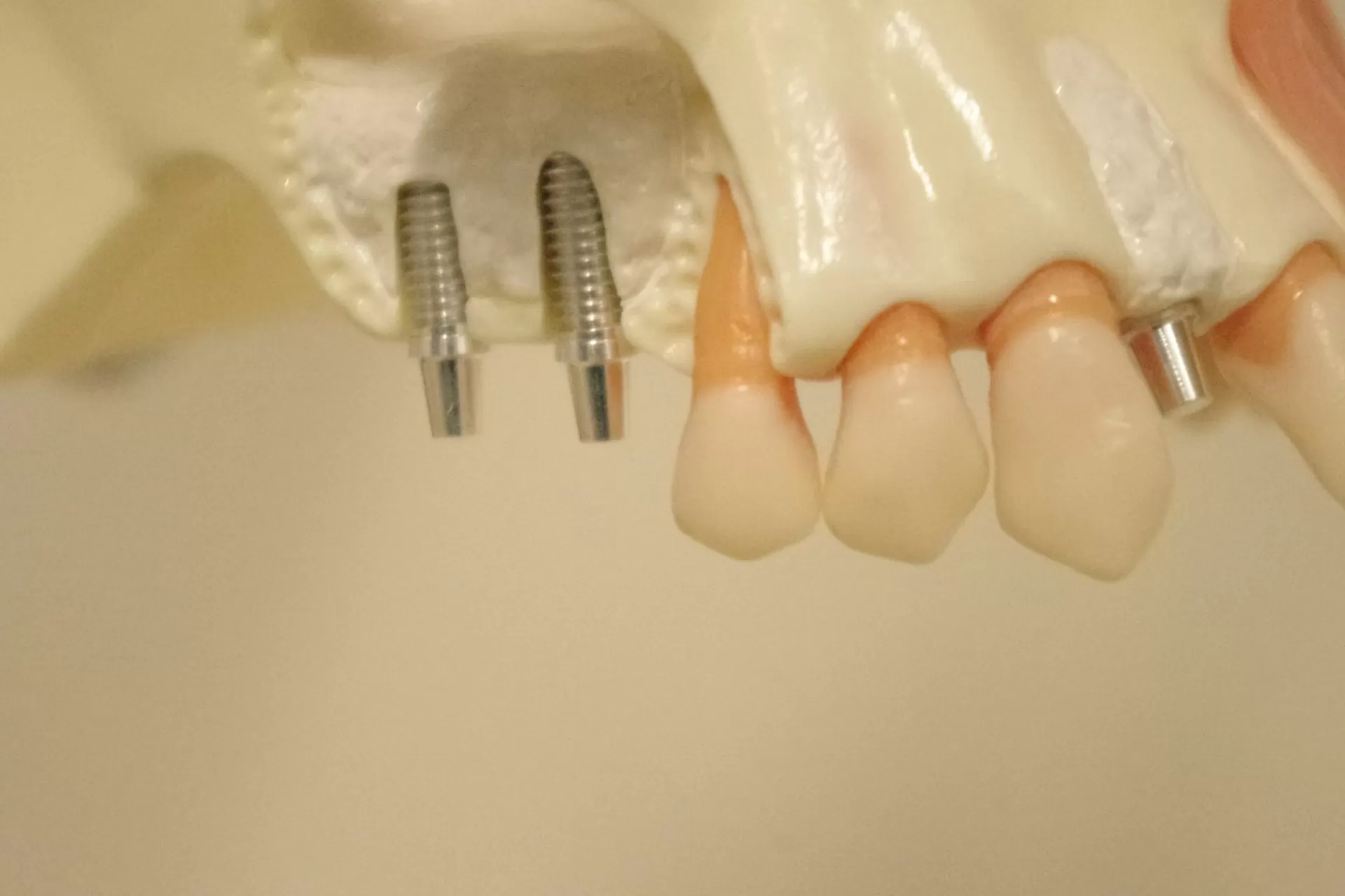 信頼性の高い最先端のインプラント