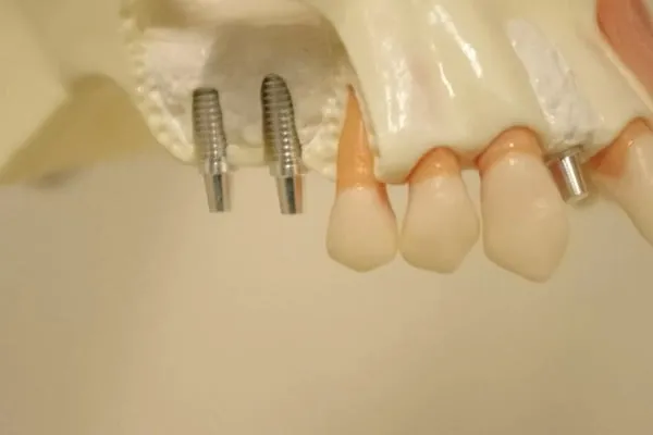 信頼性の高い最先端のインプラント