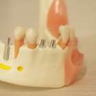 インプラント治療