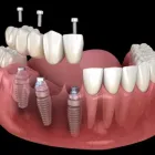 他院でインプラントができないと断られてしまった方