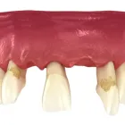 ボロボロの歯の治療